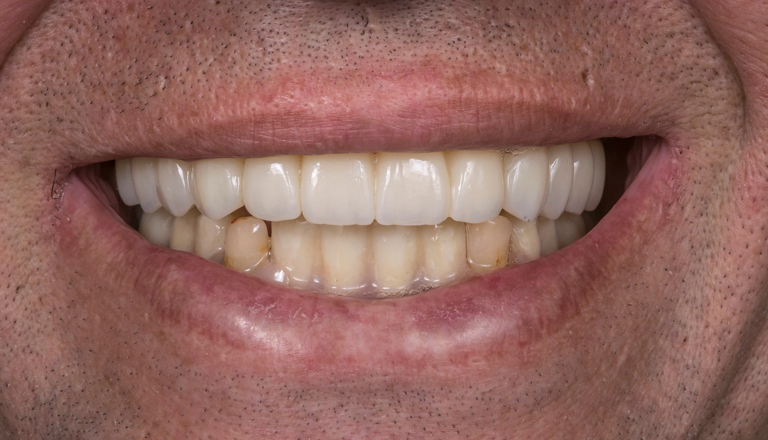 From a Failed Prosthetic Restoration to a Predictable All-on-6 Smile